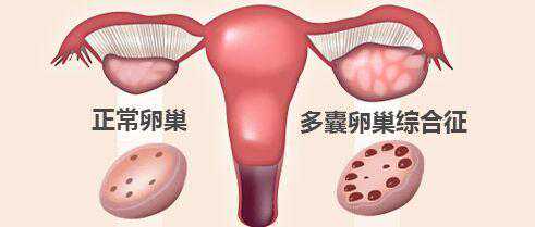确诊卵巢囊肿很着急，科学调理终于成功生男娃！